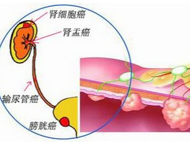 肾盂肿瘤