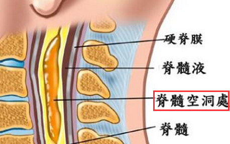 脊髓空洞症