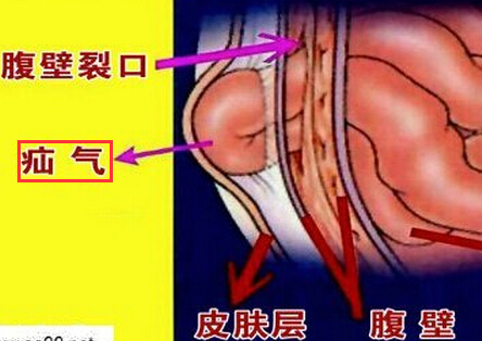 腹股沟疝气