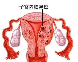 子宫内膜异位症