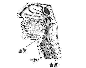 会厌炎