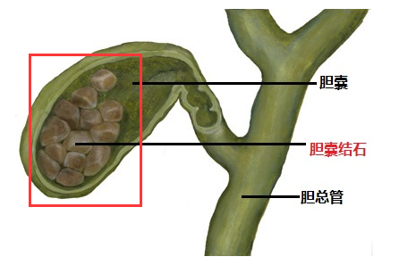 胆囊结石.png