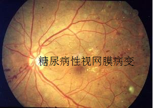 糖尿病性视网膜病变