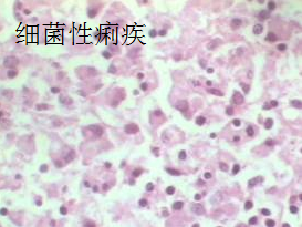 细菌性痢疾传染性很强