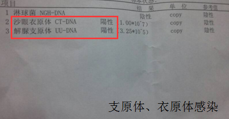 治疗支原体衣原体感染的误区