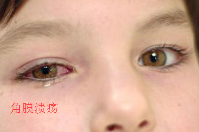 角膜溃疡.png
