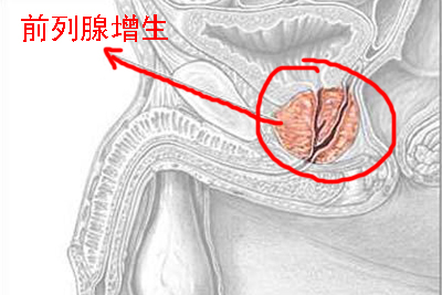 前列腺增生0.jpg