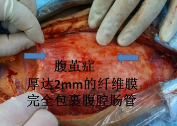 腹茧症.png