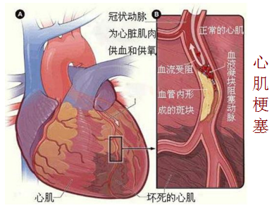 心肌梗死