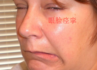 眼脸痉挛.png