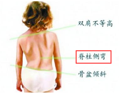脊柱侧弯.png