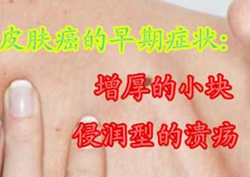 皮肤癌.png