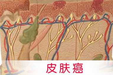 皮肤癌.png