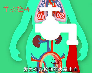 羊水栓塞.png