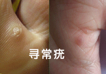 寻常疣.png