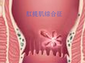 肛提肌综合征.png
