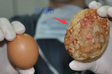 尿结石.png