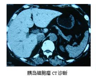 胰岛细胞瘤.png