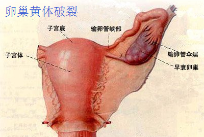 卵巢黄体破裂.png