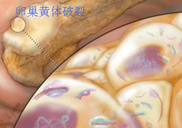 卵巢黄体破裂.png
