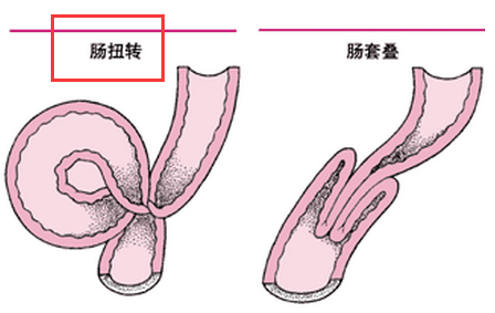 肠扭转.png