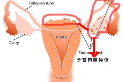 子宫内膜异位症.jpg