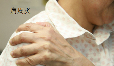 肩周炎