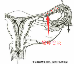 输卵管炎.png