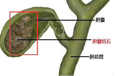 胆囊结石.png
