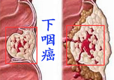 下咽癌.jpg