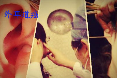 外耳道癌.jpg