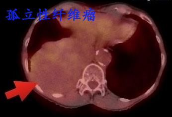 孤立性纤维瘤.jpg