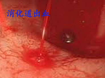 消化道出血.jpg