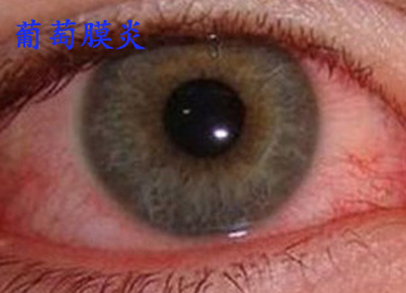 葡萄膜炎.jpg