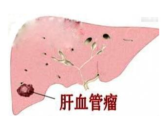 肝血管瘤.png