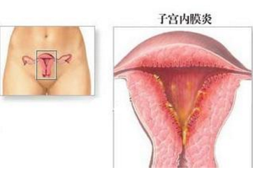 子宫内膜炎.png