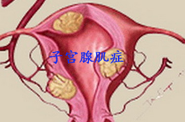子宫腺肌.jpg