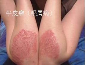 牛皮癣.png