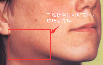 干燥综合征.png