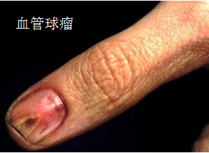 血管球瘤.png