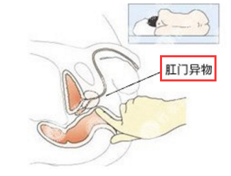 肛门异物.png