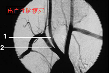 脑梗死.png
