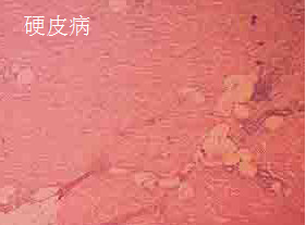硬皮病.png