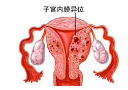 子宫内膜异位症怀孕几率大吗
