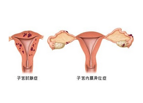 子宫内膜异位的传统疗法