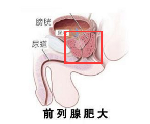 前列腺肥大