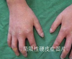 手脚变黑,硬皮病