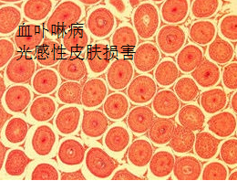 血卟啉病