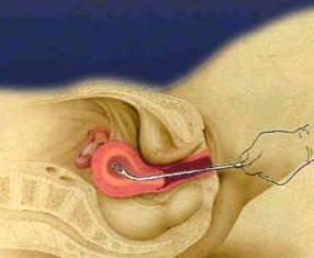 刮宫术,子宫内膜异位症病因