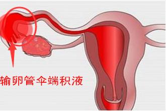 输卵管积水